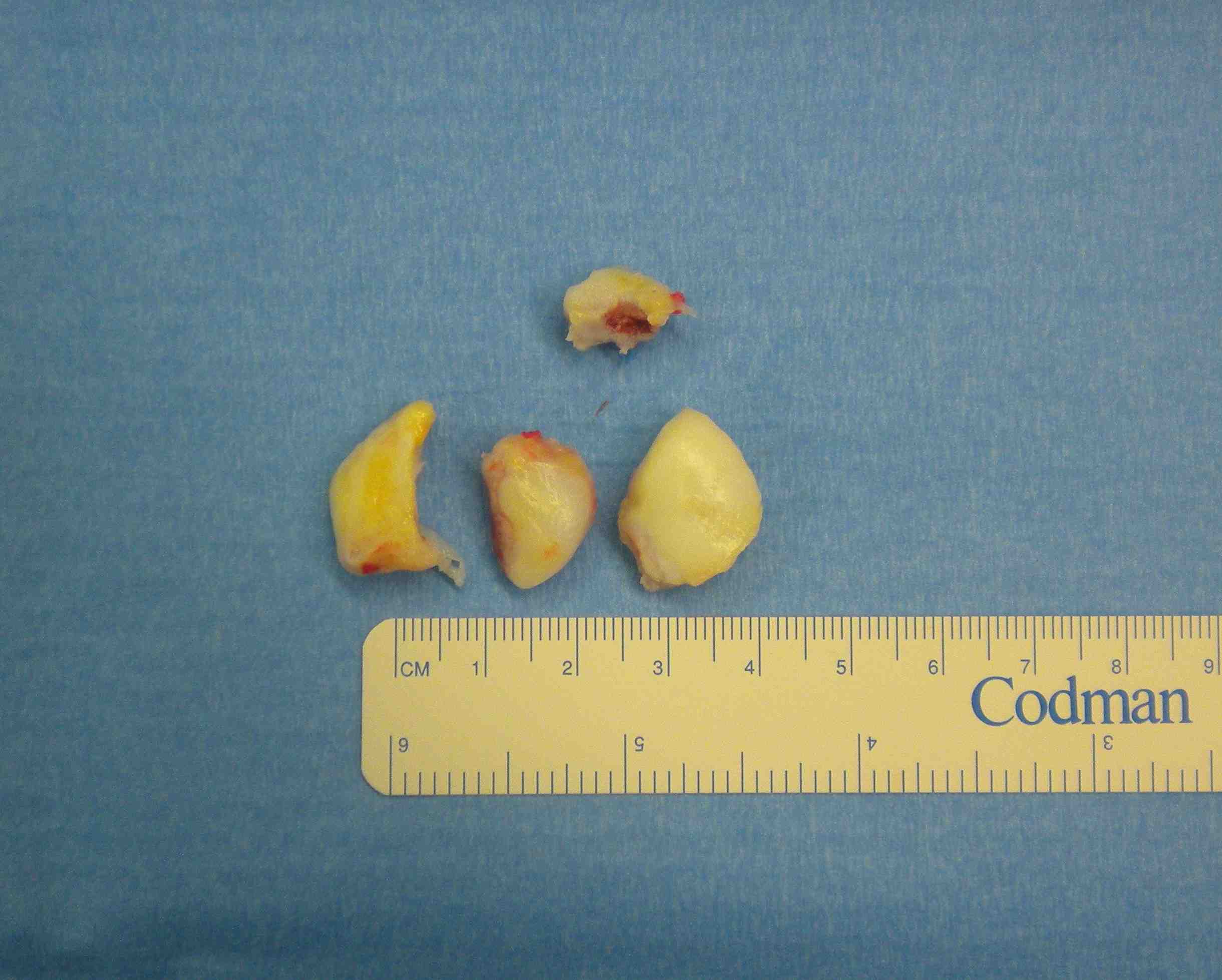 Knee OCD Fragments